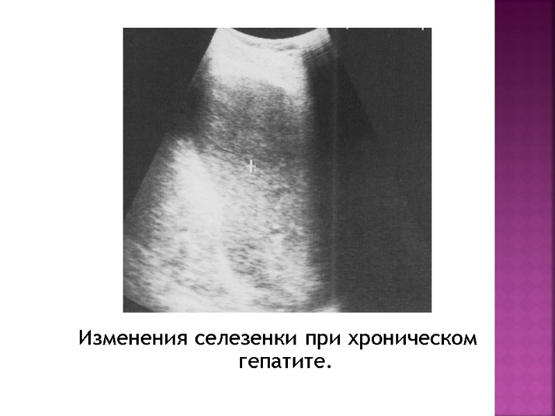 Изменения селезенки при хроническом гепатите.